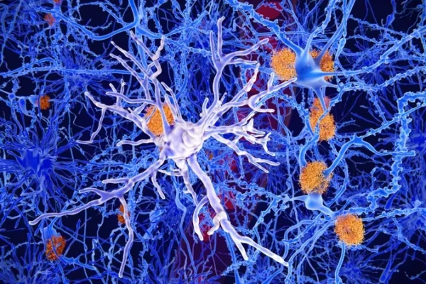 Patient defies genetic fate to avoid Alzheimer’s